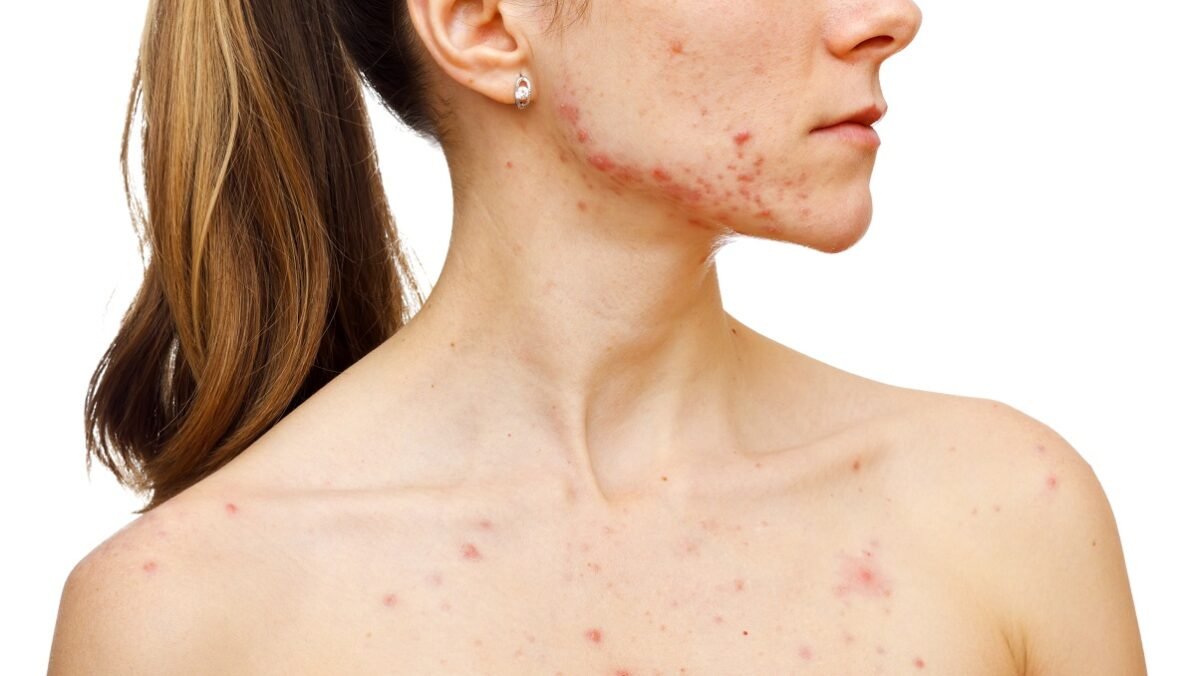 Acne da Mulher Adulta